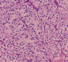 Clear cell carcinoma of the left kidney (Courtesy Dr. V. Penopoulos)