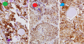 Green dot: Strong positivity for calcitonin. Red dot: Weak positivity for TTF-1 (Thyroid Transcription Factor). Blue dot: Strong positivity for Cytokeratin 7 (Courtesy Dr. V. Penopoulos)