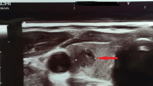 Cervical ultrasound. Medullary carcinoma. Visible microcalcifications (Courtesy Dr. V. Penopoulos)