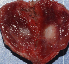 Collision type papillary/medullary carcinoma (Courtesy Dr. V. Penopoulos)