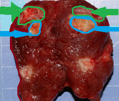 Collision type papillary/medullary carcinoma (Courtesy Dr. V. Penopoulos)