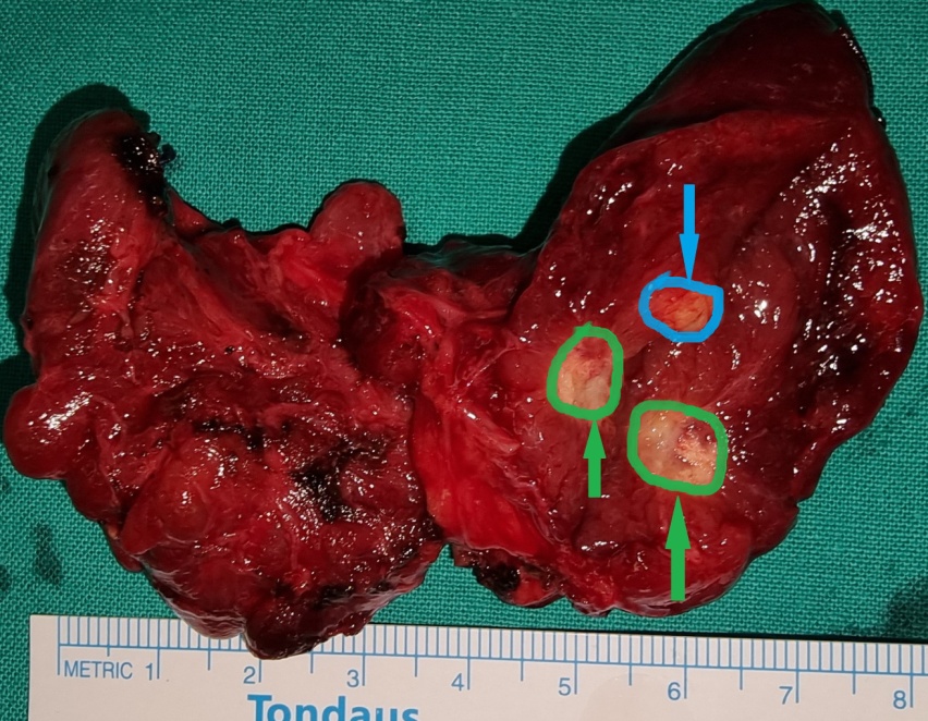 Type III. Green arrows: Sectioned papillary carcinoma of the right thyroid lobe. Blue arrow: Medullary carcinoma of the right thyroid lobe. The two cancers are clearly separated by normal thyroid parenchyma (Courtesy Dr. V. Penopoulos)