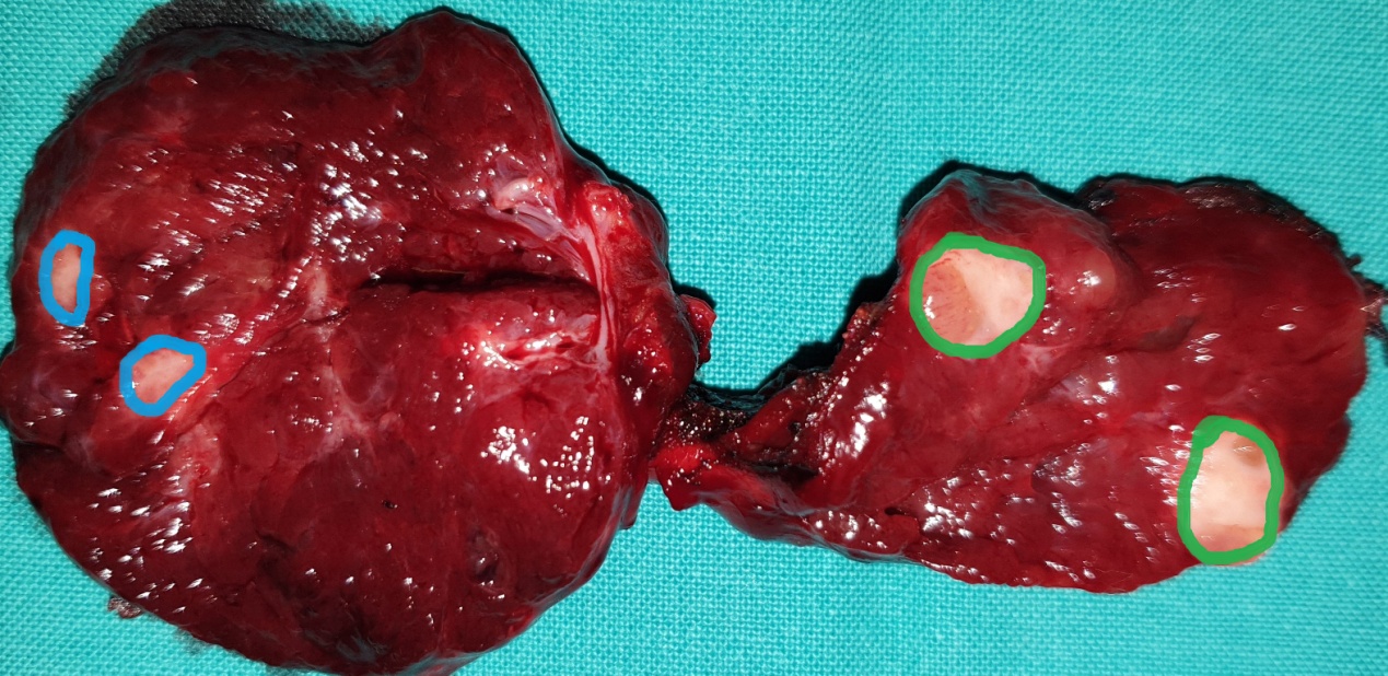 Green outline: Papillary carcinoma of the right thyroid lobe. Blue outline: Medullary carcinoma of the left thyroid lobe (Courtesy Dr. V. Penopoulos)