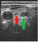 Cervical ultrasound. Green arrow: Papillary carcinoma. Red arrow: Medullary carcinoma (Courtesy Dr. V. Penopoulos)