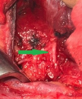 Freed right inferior laryngeal nerve (Courtesy Dr. V. Penopoulos)