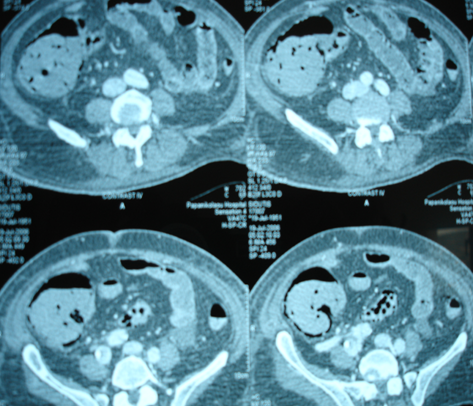 CT Angiography. Ischemic changes of the gastrointestinal tract (Courtesy Dr. V. Penopoulos)