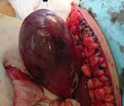 Necrosis of the gallbladder (Courtesy Dr. V. Penopoulos)