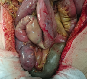 Necrosis of the small intestine (Courtesy Dr. V. Penopoulos)