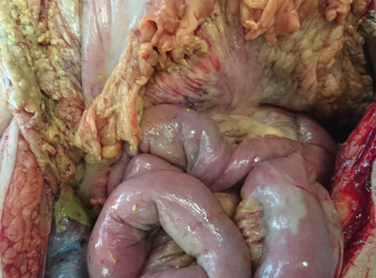 Necrosis of the right hemicolon (Courtesy Dr. V. Penopoulos)