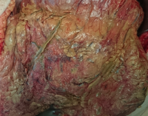 Necrosis of the greater omentum (Courtesy Dr. V. Penopoulos)