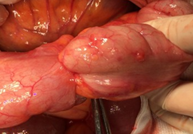 Απόφραξη τερματικού ειλεού (Ευγενική παραχώρηση Dr. V. Penopoulos)