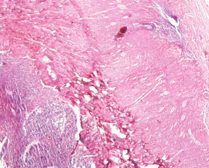 Εστία στρωματικής ενδομητρίωσης στο μυϊκό χιτώνα του ειλεού (Ευγενική παραχώρηση Dr. V. Penopoulos)