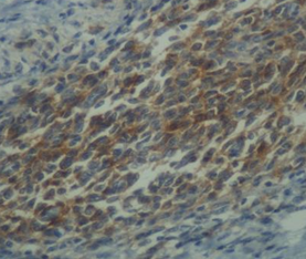 Ανοσοϊστοχημική εξέταση που καταδεικνύει θετικότητα CD10 εντός ενδομητρικών στρωματικών κυττάρων (Ευγενική παραχώρηση Dr. V. Penopoulos)