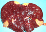 Splenic pseudotumor (Courtesy Dr. V. Penopoulos)