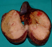 Portal hypertension (Courtesy Dr. V. Penopoulos)