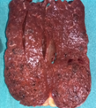 Splenic angiosarcoma (Courtesy Dr. V. Penopoulos)