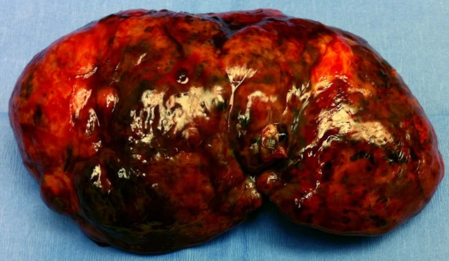 Typhoid fever - Splenic abscesses (Courtesy Dr. V. Penopoulos)