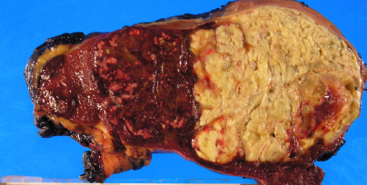 Typhoid fever - Splenic abscesses (Courtesy Dr. V. Penopoulos)