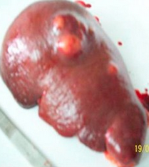 Typhoid fever - Splenic abscesses (Courtesy Dr. V. Penopoulos)