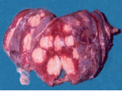 Splenic abscesses (Courtesy Dr. V. Penopoulos)