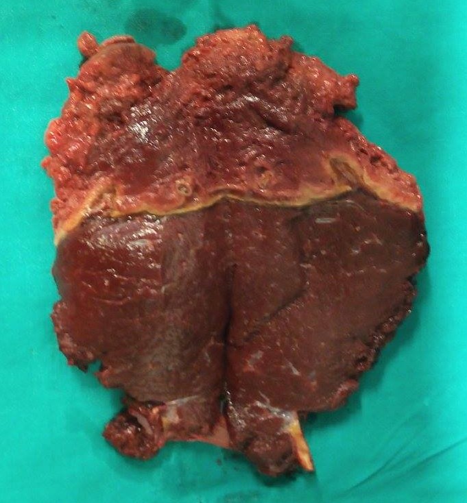 Echinococcosis of the spleen (Courtesy Dr. V. Penopoulos)