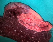 Hodgkin lymphoma of the spleen (Courtesy Dr. V. Penopoulos)