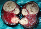 Splenic hematoma (Courtesy Dr. V. Penopoulos)