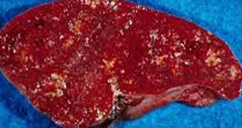 Splenic tuberculosis (Courtesy Dr. V. Penopoulos)