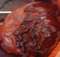 Splenic metastasis (Courtesy Dr. V. Penopoulos)