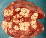 Splenic sarcoidosis (Courtesy Dr. V. Penopoulos)
