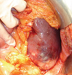 Splenic infarcts (Courtesy Dr. V. Penopoulos)