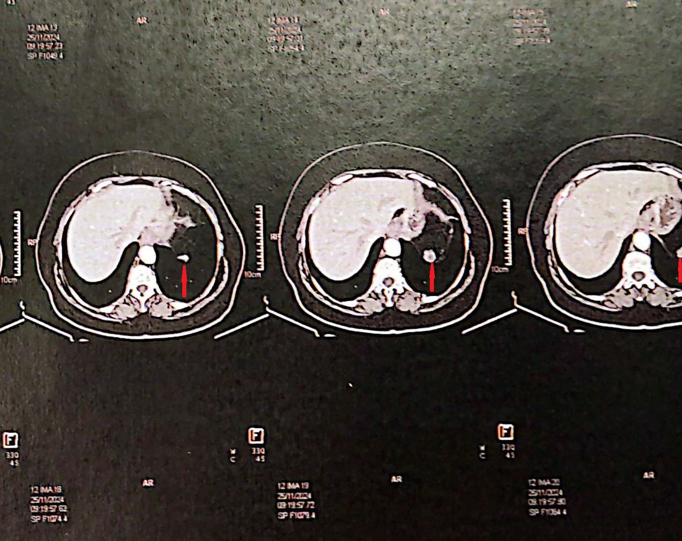Upper abdominal CT scan 1 year after splenic autotransplantation. Enhancement of the transplanted splenic tissue after contrast injection is evident, demonstrating its viability and function (Courtesy Dr. V. Penopoulos)