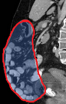 Lateral view demonstrating the size of the recurrent incisional hernia (Courtesy Dr. V. Penopoulos)
