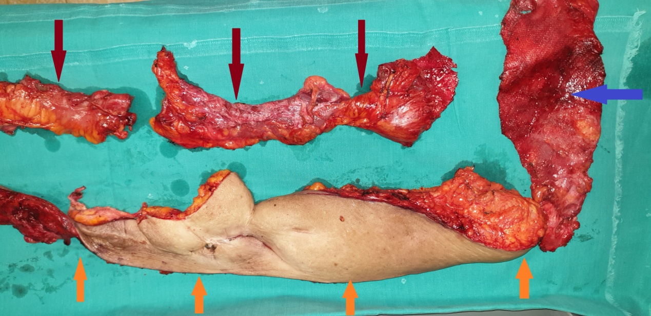 Orange arrows: Adipocutaneous flaps. Purple arrow: Removed mesh. Brown arrows: Enterectomies (Courtesy Dr. V. Penopoulos)