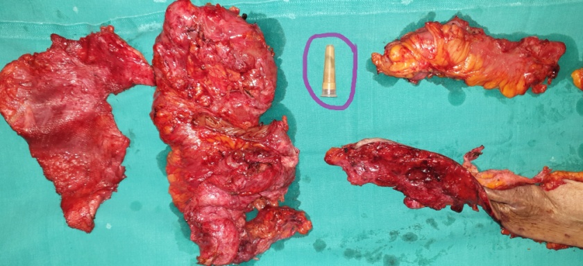 Purple circle: Removed foreign body from the right iliac fossa (most likely a severed segment of Robinson drain) (Courtesy Dr. V. Penopoulos)