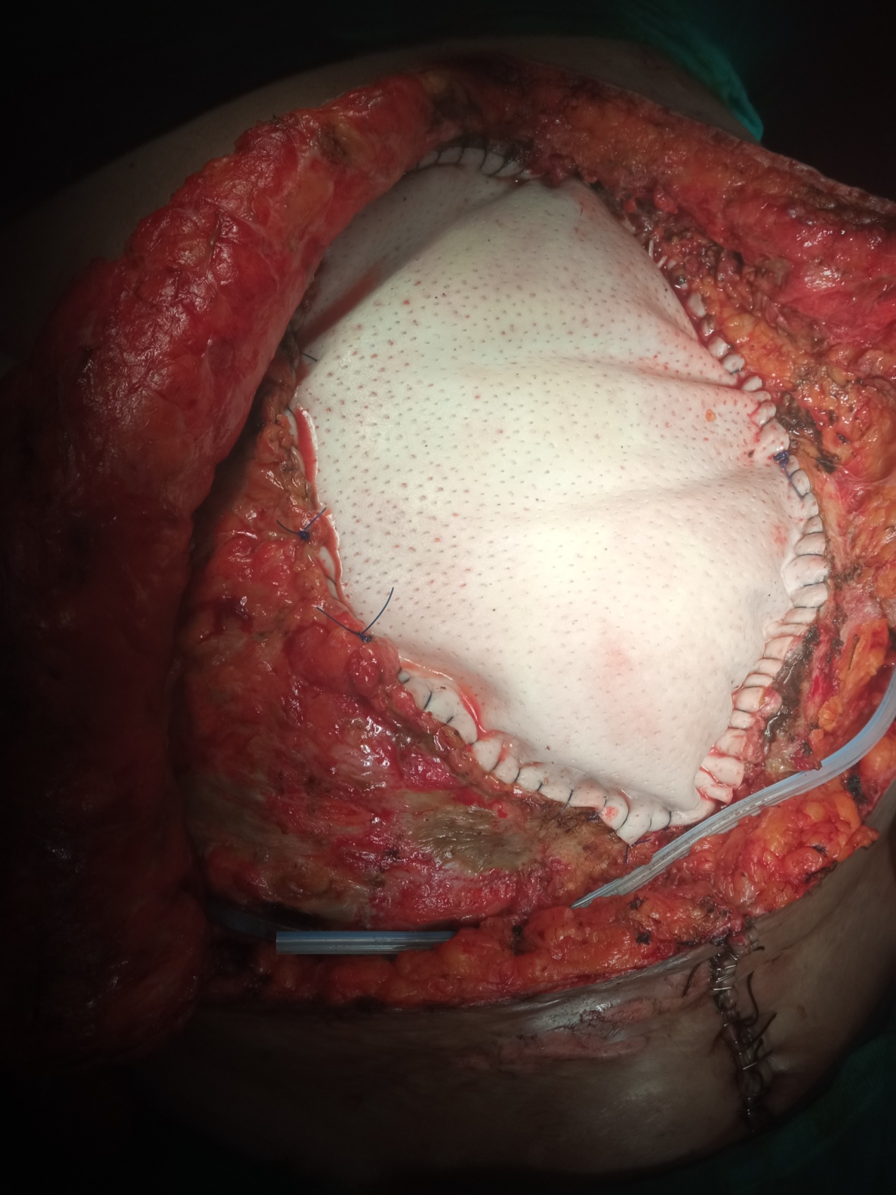 Barium study. Encapsulated small bowel loops (Courtesy Dr. V. Penopoulos)