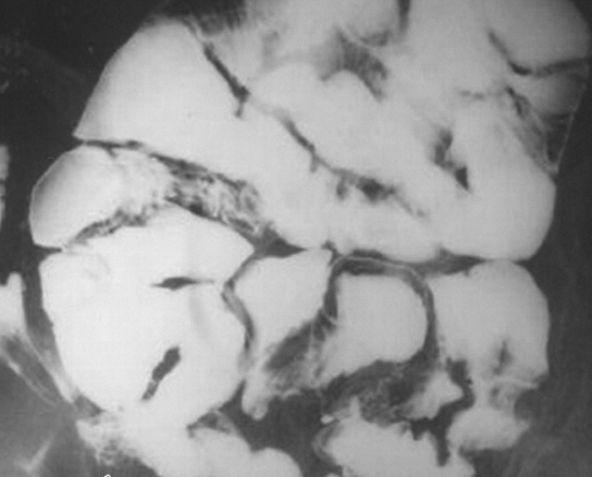 Barium study. Encapsulated small bowel loops (Courtesy Dr. V. Penopoulos)
