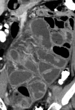 Abdominal MRI. Encapsulated small bowel loops (Courtesy Dr. V. Penopoulos)