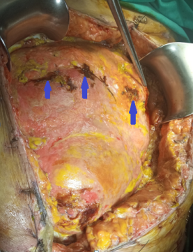 Purple arrows: Sites of small bowel perforation. Encapsulation of the entire peritoneal cavity (Courtesy Dr. V. Penopoulos)