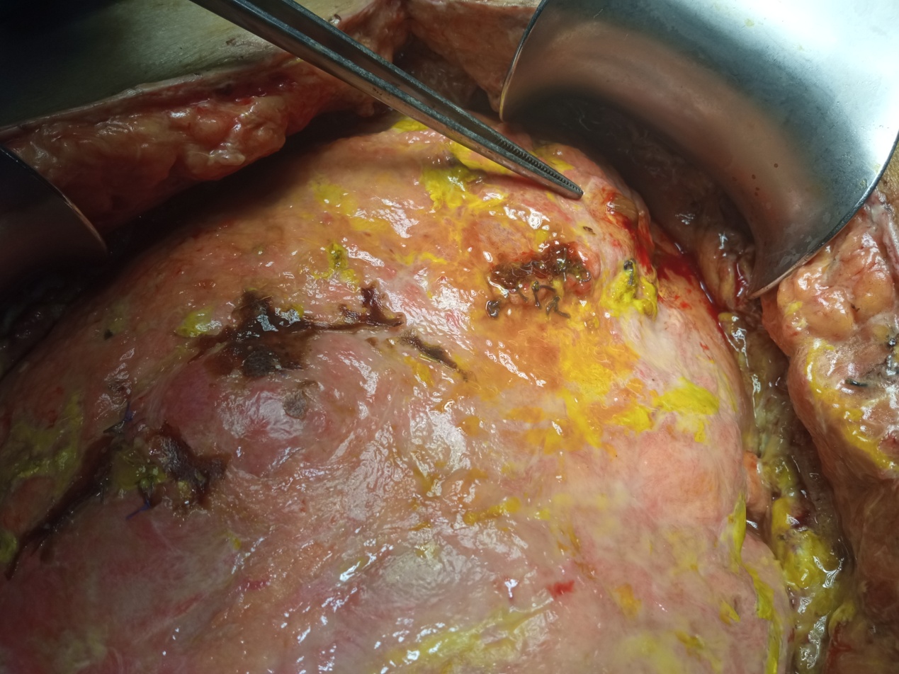 Purple arrows: Sites of small bowel perforation. Encapsulation of the entire peritoneal cavity (Courtesy Dr. V. Penopoulos)