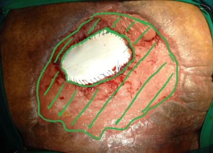 Green shading: Complete occupation of the abdomen by the peritoneal "cocoon" (Courtesy Dr. V. Penopoulos)