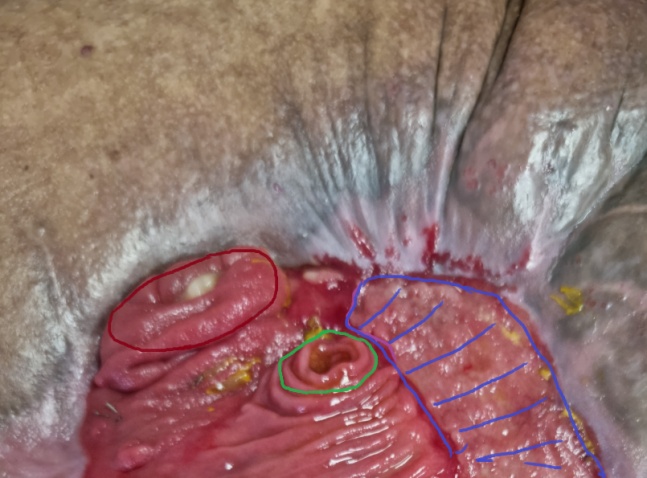 Purple outline: Complete coverage of the abdomen by the "cocoon". Green outline: Enterostomy. Brown outline: Peripheral opening of disrupted bowel loop (Courtesy Dr. V. Penopoulos)