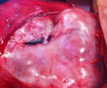 Types of primary sclerosing encapsulating peritonitis (Courtesy Dr. V. Penopoulos)