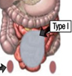 Ultrasound examination. Red arrows: Thickened peritoneum (Courtesy Dr. V. Penopoulos)