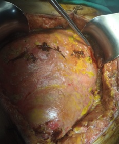 Ultrasound examination. Red arrows: Thickened peritoneum (Courtesy Dr. V. Penopoulos)