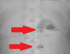 Abdominal CT. Abdominal "cocoon". Encapsulated bowel loops (Courtesy Dr. V. Penopoulos)