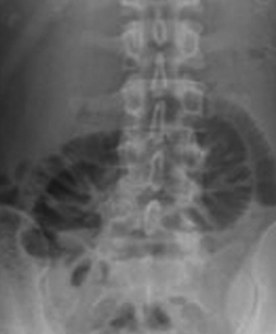 Abdominal CT. Abdominal "cocoon". Encapsulated bowel loops (Courtesy Dr. V. Penopoulos)