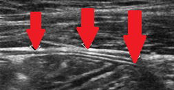 Abdominal MRI. Abdominal "cocoon" (Courtesy Dr. V. Penopoulos)