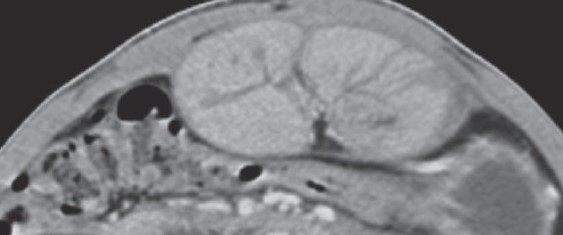 Normal abdominal CT scan. Normal anatomical structures of the abdominal walls (Courtesy Dr. V. Penopoulos)