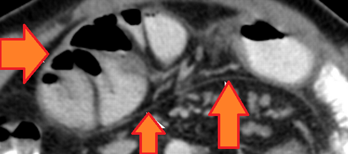 Normal abdominal CT scan. Normal anatomical structures of the abdominal walls (Courtesy Dr. V. Penopoulos)